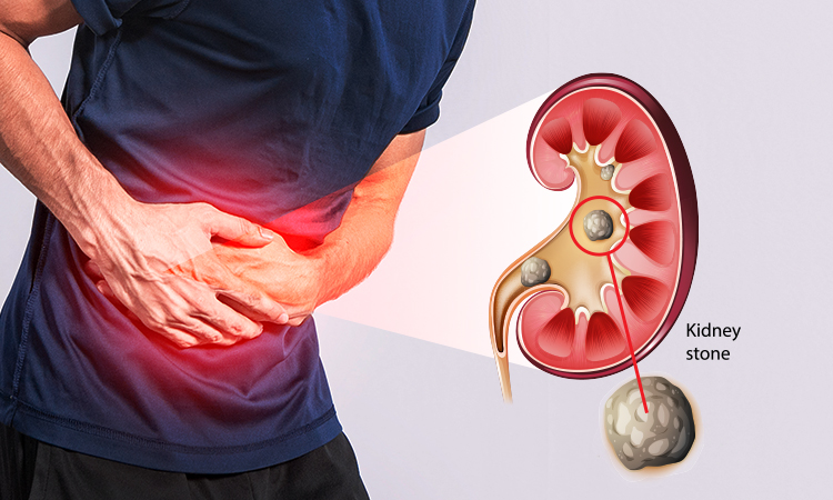 Kidney Health: మీ కిడ్నీలు పదిలంగా ఉండాలంటే.. ఈ వేసవిలో తీసుకోవాల్సిన జాగ్రత్తలు ఇవే!